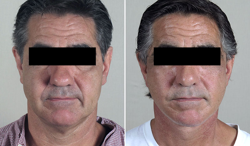 Male Facelift Patient 7