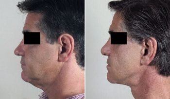 Male Facelift Patient 7