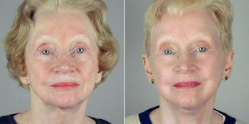 Face Lift Patient 28