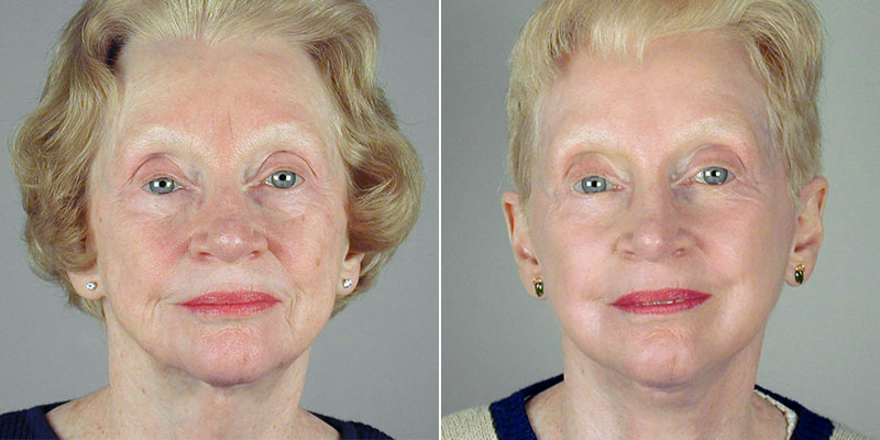 Face Lift Patient 28