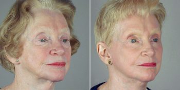 Face Lift Patient 28
