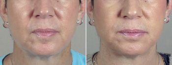 Angela’s Patient 1 – Restylane