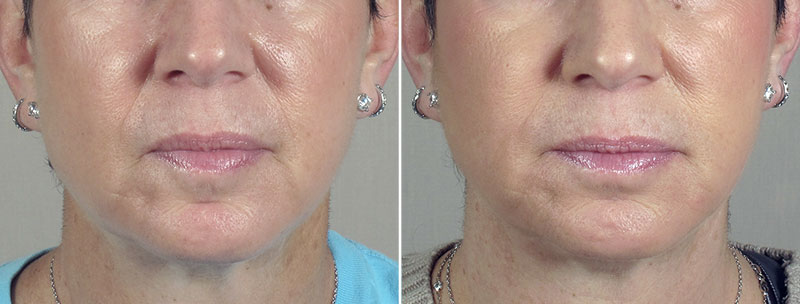 Angela’s Patient 1 – Restylane