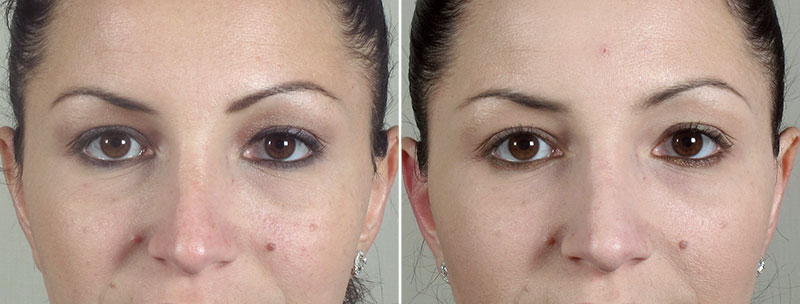 Angela’s Patient 2 – Restylane