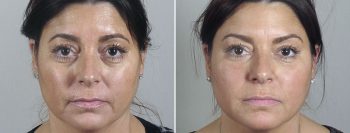 Angela’s Patient 3 – Restylane & Dysport