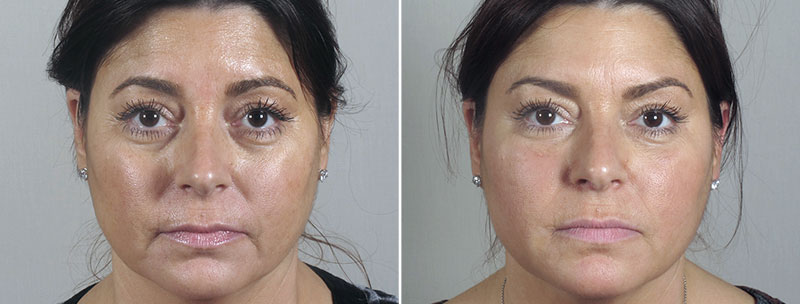 Angela’s Patient 3 – Restylane & Dysport