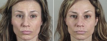 Angela’s Patient 4 – Dysport