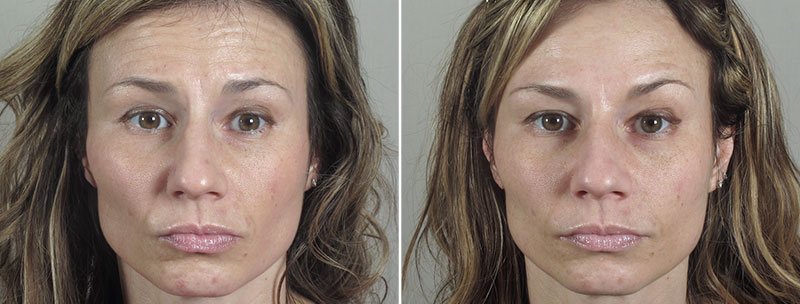 Angela’s Patient 4 – Dysport