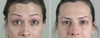 Angela’s Patient 6 – Dysport