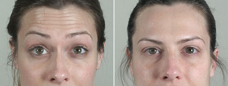 Angela’s Patient 6 – Dysport