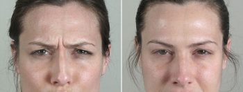 Angela’s Patient 6 – Dysport