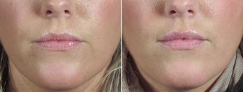 Angela’s Patient 7 – Restylane