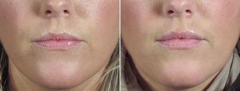 Angela’s Patient 7 – Restylane