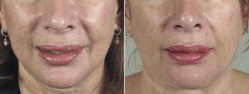 Angela’s Patient 8 – Restylane