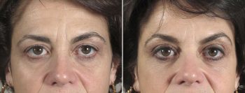 Angela’s Patient 9 – Restylane & Dysport
