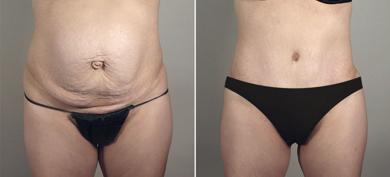 Liposuction Patient 58
