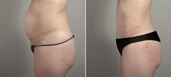Liposuction Patient 58