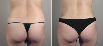 Liposuction Patient 58