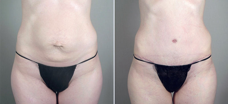 Parker Tummy Tuck Patient 45