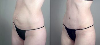 Parker Tummy Tuck Patient 45