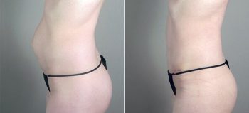 Parker Tummy Tuck Patient 45