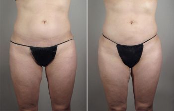 Upper Arm Rejuvenation Patient 13 – Liposuction