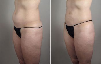 Upper Arm Rejuvenation Patient 13 – Liposuction