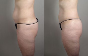 Upper Arm Rejuvenation Patient 13 – Liposuction