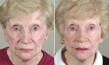 Face Lift Patient 28