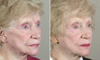Face Lift Patient 28