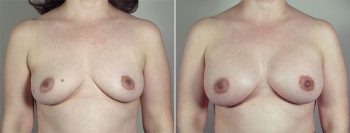 Breast Enlargement (Augmentation) Patient 81