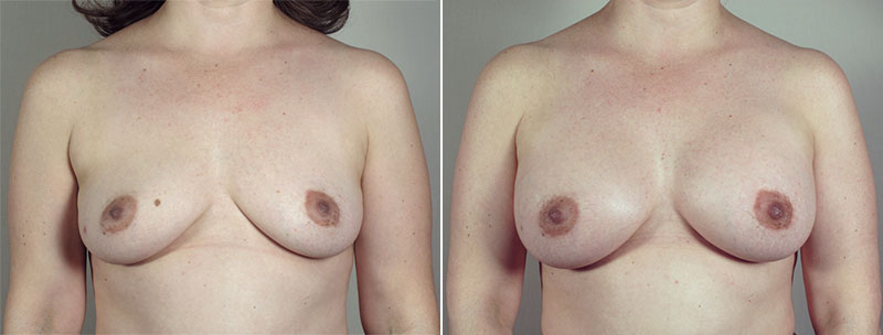 Breast Enlargement (Augmentation) Patient 81