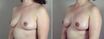 Breast Enlargement (Augmentation) Patient 81