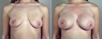 Breast Enlargement (Augmentation) Patient 83