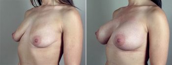 Breast Enlargement (Augmentation) Patient 83