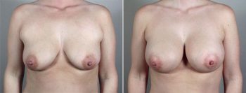 Breast Enlargement (Augmentation) Patient 82