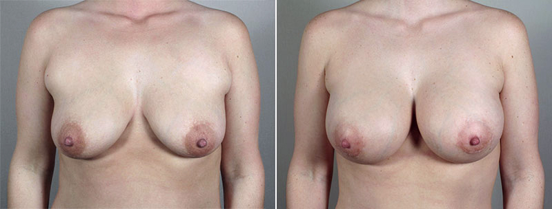 Breast Enlargement (Augmentation) Patient 82