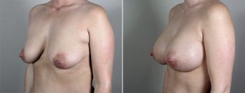 Breast Enlargement (Augmentation) Patient 82