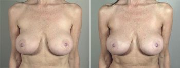 Removal & Replacement of Implants Patient 27