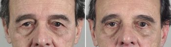 Male Eyelid Lift Patient 10
