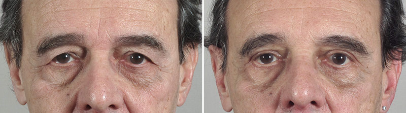 Male Eyelid Lift Patient 10