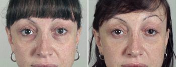 Lower Eyelid Lift Patient 11