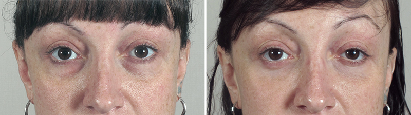 Lower Eyelid Lift Patient 11