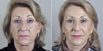 Face Lift Patient 29