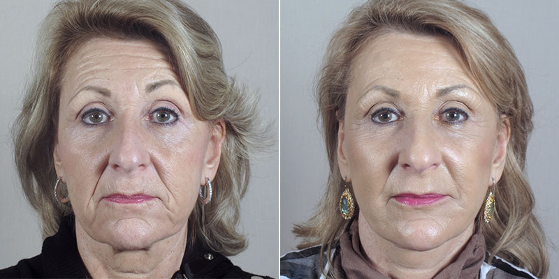 Face Lift Patient 29