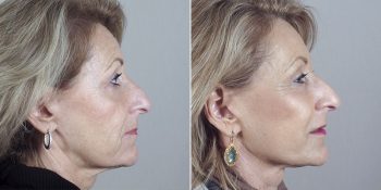 Face Lift Patient 29