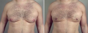 Gynecomastia Reduction Patient 42