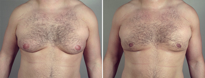 Gynecomastia Reduction Patient 42
