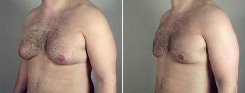 Gynecomastia Reduction Patient 42