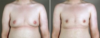 Gynecomastia Reduction Patient 41